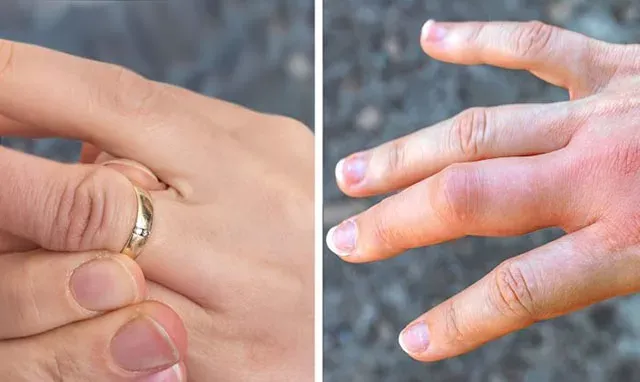 Cách xử lý khi nhẫn cưới bị kẹt không lấy ra được khỏi ngón tay